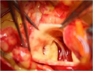 Reimplantation of anomalous right coronary artery in the anterior sinus.