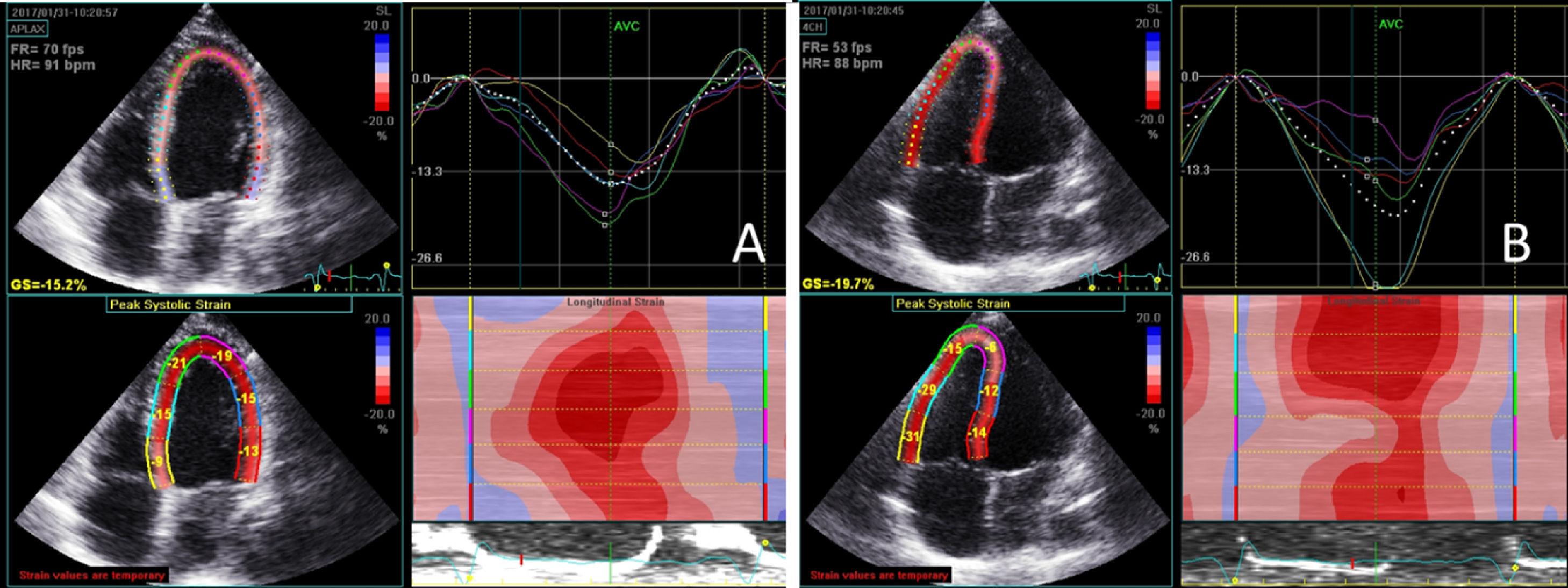 Longitudinal strain by two-dimensional speckle tracking to assess  ventricular function in adults with transposition of the great arteries:  Can serial assessment be simplified?