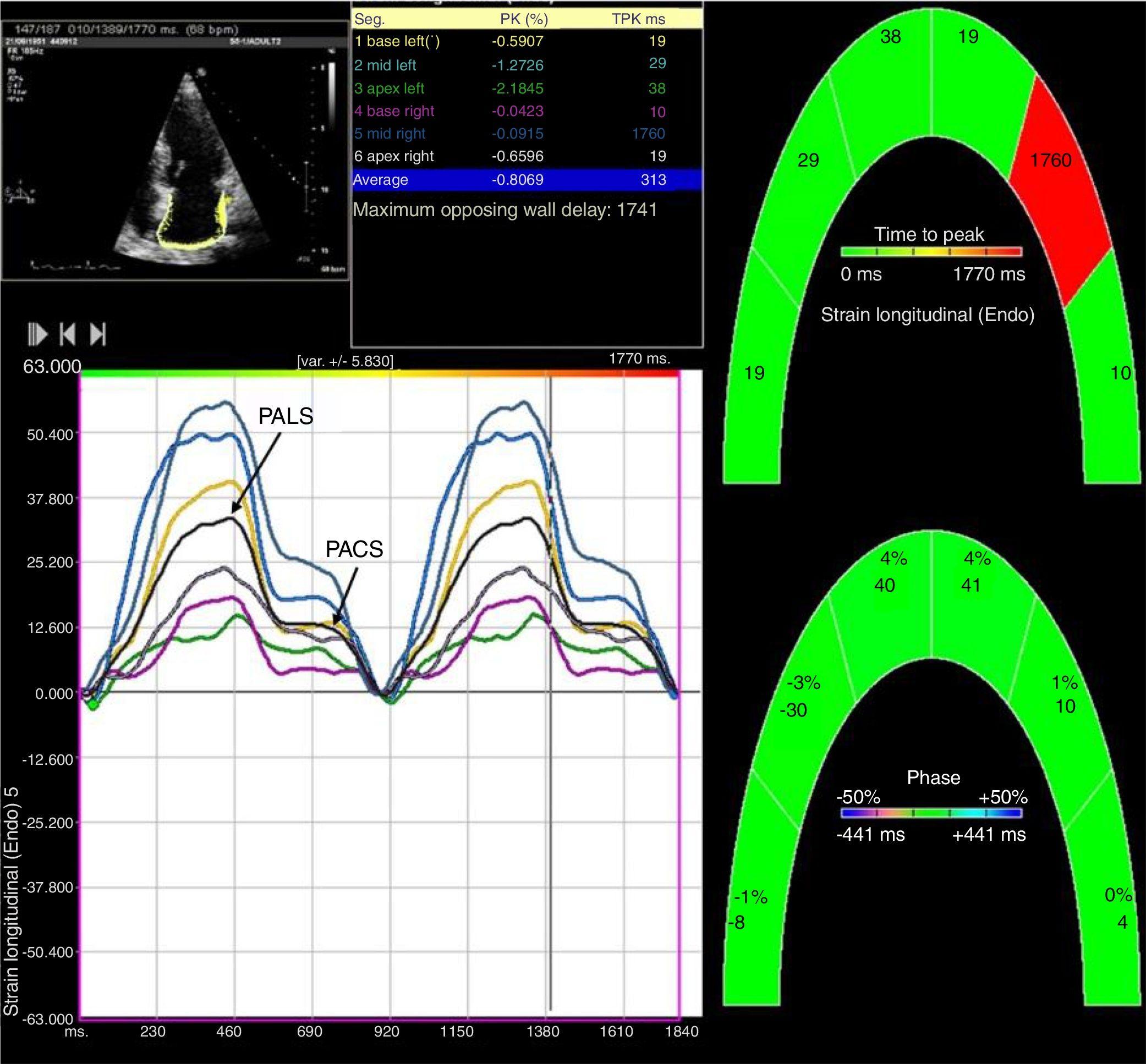 Evaluation of left ventricular global functions with speckle tracking  echocardiography in patients recovered from COVID-19