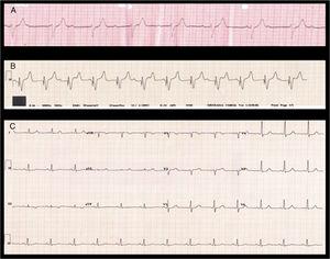 Electrocardiograms: A) Third-degree atrioventricular block during advanced cardiopulmonary resuscitation. B) Pacemaker-stimulated ventricular rhythm with atrioventricular dissociation. C) Sinus rhythm with normal atrioventricular conduction and narrow QRS.