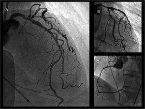 Coronary angiogram: A) Left anterior descending artery with diffuse atherosclerosis but no apparent severe obstructive lesions. B) Left coronary artery, circumflex artery branches and left anterior descending artery from another point of view. C) Right coronary artery.