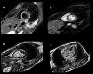Cardiac magnetic resonance: A) Increased short inversion time inversion recovery signal intensity, indicating septal edema. B) Subendocardial perfusion defect in the same area. C and D) Transmural delayed enhancement at the same level with no viability, confirming the diagnosis of acute septal myocardial infarction.