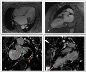 Cine gradient echo magnetic resonance imaging sequences in 4-chamber (A) and 2-chamber view (B), showing a hypointense mass (star) in the inferior and lateral region of the mitral annulus, extending to the inferior basal segment; delayed postcontrast images showing late enhancement at the periphery of the lesion (C, arrowhead) and transmural late enhancement in the inferior mid-apical and apex segments (D, arrow).