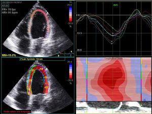 Left ventricular strain analysis using speckle tracking technology.