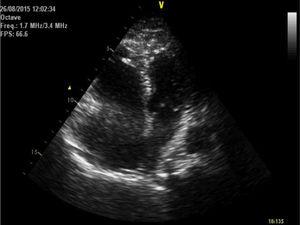 Four-chamber apical view performed at the emergency room, showing a dilated right ventricle.