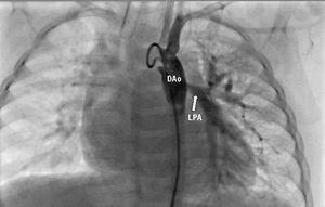 Aortic angiography demonstrating anomalous origin of the left pulmonary artery from the descending thoracic aorta. LPA: left pulmonary artery; DAo: descending Aorta.