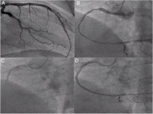 Second angiography and angioplasty on day 2 of hospitalization: (A) left coronary artery confirming good outcome; (B) right coronary angiography showing diffuse right coronary artery disease from the proximal segment to the crux, with distal dissection; (C) implantation of the last stent, 3.5 mm×38 mm Resolute Onyx; (D) final result of the second right coronary angioplasty.
