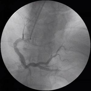 Coronary angiography with slow flow and non-obstructive disease.