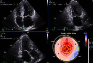 Revaluation echocardiogram with moderate left ventricular concentric hypertrophy and preserved ejection fraction.
