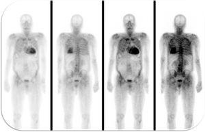 99mTc-DPD scintigraphy revealed significant myocardial tracer uptake, diagnosing TTR amyloid infiltration.
