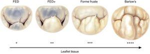 Spectrum of degenerative mitral valve disease (from 19). FED: fibroelastic deficiency.