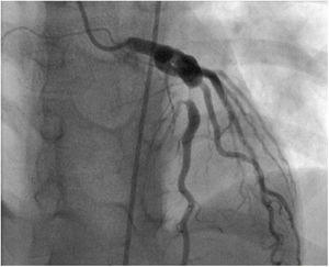 Coronary angiography showing coronary artery aneurysm of the anterior descending coronary artery measuring 17 mm×7 mm and involving the first diagonal branch, associated with 90% post-aneurysmal stenosis.
