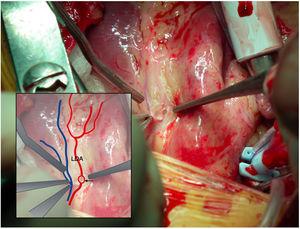 Intraoperative photograph showing site of distal anastomosis (arrow) in the left anterior descending coronary artery.