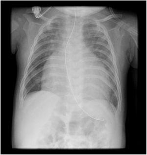 Chest radiography showing cardiomegaly and pulmonary congestion.