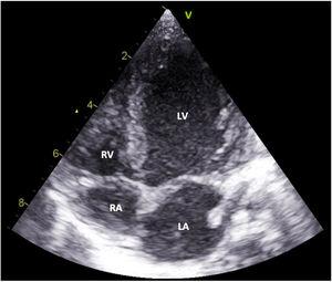 Transthoracic echocardiography (4-chamber view), with severe dilatation of the left atrium and left ventricle. LA: left atrium; LV: left ventricle; RA: right atrium; RV: right ventricle.