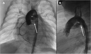Cardiac catheterization: (A) anteroposterior view: aortography revealed normal origin of the coronary arteries with a hypoplastic left coronary artery (arrow), and clear presence of an extracardiac left-to-right shunt, which was later found to be mostly due to the presence of an aortopulmonary window (*); (B) lateral view: selective aortic angiography showed the presence of a patent ductus arteriosus (arrow), which was deemed unsuitable for percutaneous closure.