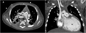 Computed tomography. Axial (A) and coronal (B) views, in which a large (10 mm×10 mm) aortopulmonary window is evident (*). The left ventricle is severely dilated. Ao: ascending aorta; P: main pulmonary artery; LV: left ventricle.