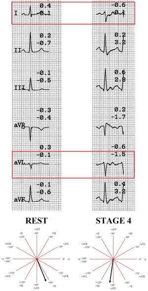 Rest versus maximum effort cardiac axis comparison. Notice the progressive change in I and aVL leads, turning a normal cardiac axis to right. This pattern is compatible with left posterior fascicular block.