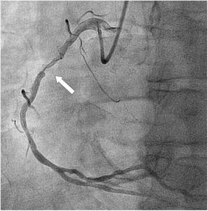 Coronary angiography showing a long lesion in mid-right coronary artery. There is severe narrowing of the lumen, critical in the distal part of the lesion.