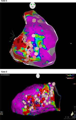 Examples of substrate-based ablations in patients with previous anteroseptal myocardial infarction (case 1) and non-ischemic cardiomyopathy with areas of scar (case 2).