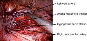 D-3 lymph node dissection with left colic artery preservation.