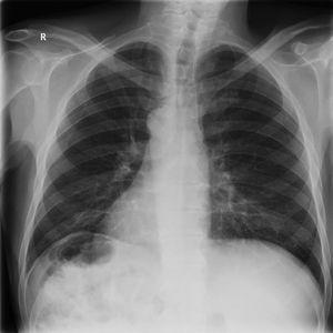 Chest X-ray showed dextrocardia and right-sided gastric air bubble.
