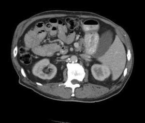 Abdominal computed tomography showed a colonic mass located in ascending colon, which was inverted on the left side.