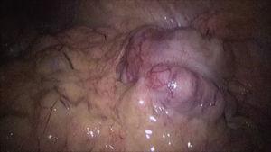 Laparoscopic view identifying colonic mass in the ascending colon located on the left of abdominal cavity.