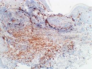 Immunohistochemistry (200×) showing membrane pattern reactivity for CD1a.
