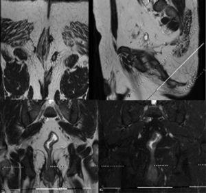 Magnetic resonance of pelvis showing 3 fistulous paths and an abscess area.