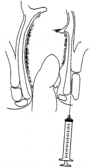 Schematic representation, in lateral section, illustrating the intersphincteric infiltration.