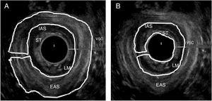 Female anal canal – middle anal canal – regions of interest. EAS, external anal sphincter; LM, longitudinal muscle; IAS, internal anal sphincter; ST, subepithelial tissues. (A) Outer structures; (B) Inner structures.