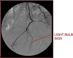 Superior rectal artery – light bulb sign.