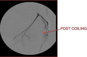 Superior rectal artery embolization using microcoil (2mm×2cm).
