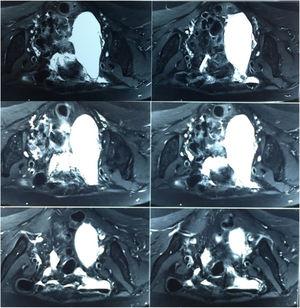 Magnetic resonance imaging showing adnexal cyst of about 11.0×4.5cm on the right, with no characteristics suggestive of malignancy.