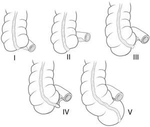 Classification of the agenesis of the vermiform appendix.