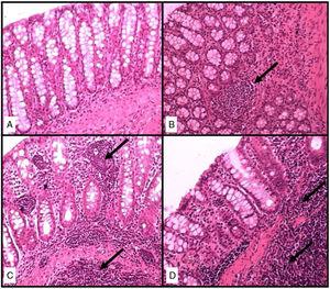 Classification of inflammatory infiltrate. (A) Normal epithelium, absence of inflammation; (B) one inflammatory focus per field; (C) two inflammatory foci per field; (D) more than two inflammatory foci per field; Inflammatory foci are characterized by the presence of lymphocytes, macrophages, dendritic cells, T lymphocytes and B lymphocytes, which have been observed in hyperplastic lymphoid follicles exhibiting colonic mucosa and submucosa atrophy (arrows); Hematoxylin-Eosin staining (200×).