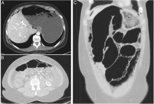 CT enterography (A, axial image; B and C, axial and coronal images, lung window) demonstrates free extra-peritoneal gas (arrows) and multiple air-filled cysts in the small bowel walls. There were no other abnormalities in the small bowel or in the colon.