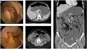 Capsule endoscopy and CT enterography images, 6 months after the acute event. Signs of pneumatosis are absent with few enteric stasis near the enteric anastomosis in CT enterography.