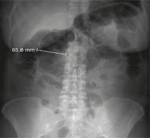 Plain abdominal radiography showing dilatation of the transverse colon.