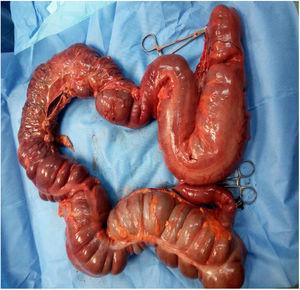 Total colectomy.