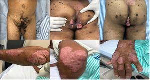 Verrucous infections in the upper 3 images. And psoriasis lesion in the under 3 images.