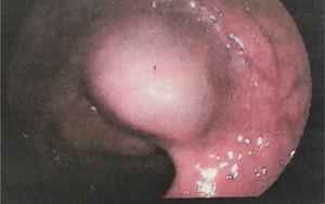 Perianastomotic lesion discovered in a follow-up colonoscopy.