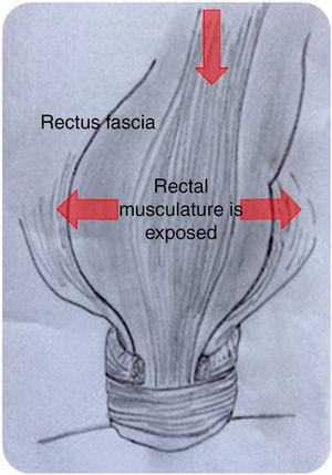 Post-trauma: laceration of the rectus fascia. Due to the trauma, the rectus fascia and recto-vaginal fascia are injured. The rectum widens, occupying the pelvis (rectocele) and descends (favoring intussusception) - arrows.