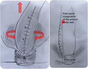 Post-repair of the fascial and sphincter rectocele defect and elongation of the rectal wall (reducing the possibility of intussusception) - arrows.