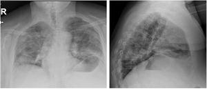 Radiografía de tórax en proyecciones anteroposterior (AP) y lateral. Infiltrados bilaterales y difusos en ambos campos pulmonares en relación con infección aguda probablemente por coronavirus.
