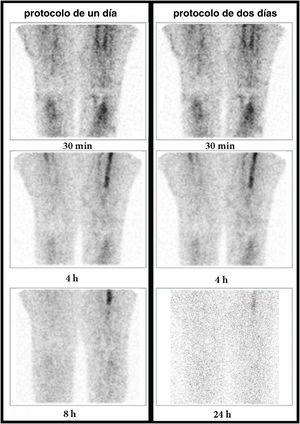Mujer de 64 años con prótesis de rodilla derecha implantada 10 años atrás (asintomática) y prótesis de rodilla izquierda desde hacía 3 años (muy dolorosa en la actualidad, con sospecha de infección de la prótesis). Imágenes de la GLM (rodillas, proyecciones anteriores) a los 30min, 4h y 8h o 24h (columna de la izquierda: protocolo de un día; columna de la derecha: protocolo de 2 días). Se observa que la captación periprotésica en la rodilla izquierda va disminuyendo progresivamente en intensidad (flechas) entre los 30min, 4h y 8h o 24h. Este comportamiento es compatible con una inflamación aséptica en ambos protocolos. Se obtuvo un cultivo negativo.