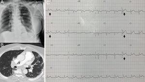 A) Chest radiography. B) CT showing thrombi in both main pulmonary arteries (arrows), in addition to interstitial infiltrates (star). C) ECG with generalised concave ST elevation.