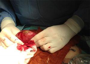 Removal, through an auxiliary incision, of the obstruction caused by gallstone ileus.