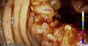Colonoscopy showing a friable lesion with irregular edges, 13cm from the anal margin, with a histopathologic diagnosis of adenocarcinoma.